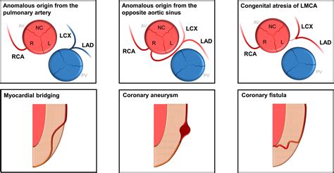 Coronary anatomy and anomalies .